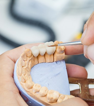 Dental professional creating custom dental bridge