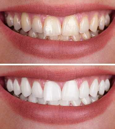 Closeup of patients' smile before and after teeth whitening