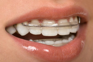 profile of dental retainers